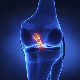 ACL Tear Treatment in Weatherford, TX