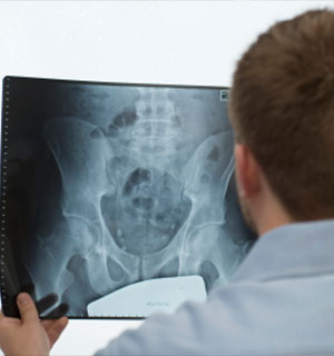 Osteoporosis Treatment in West Hollywood, CA